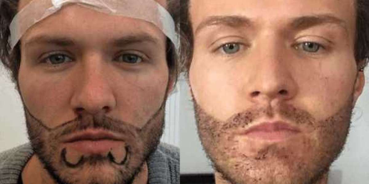 Implante de barba resultados